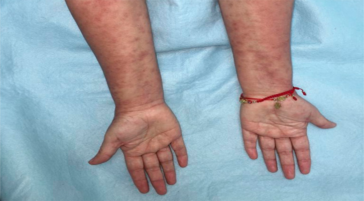 Recomienda IMSS mantener piel hidratada en pacientes con dermatitis atópica